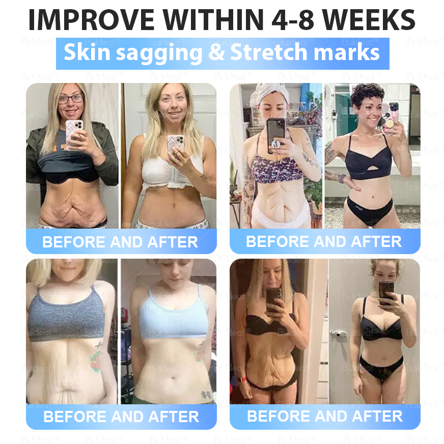 Clinically Proven✨| Official Store |🌸 Buildleaf® Tirzepatide Slimming & Health Nano Microneedle Patch |Targets Obesity, Loose Skin, High Blood Pressure, Diabetes, Fatty Liver, Joint Pain, Brain Fog, Low Energy, Body Aches, and More
