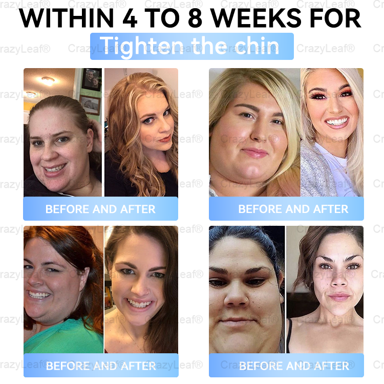 Clinically Proven✨| Official Store |🌸 Buildleaf® Tirzepatide Slimming & Health Nano Microneedle Patch |Targets Obesity, Loose Skin, High Blood Pressure, Diabetes, Fatty Liver, Joint Pain, Brain Fog, Low Energy, Body Aches, and More