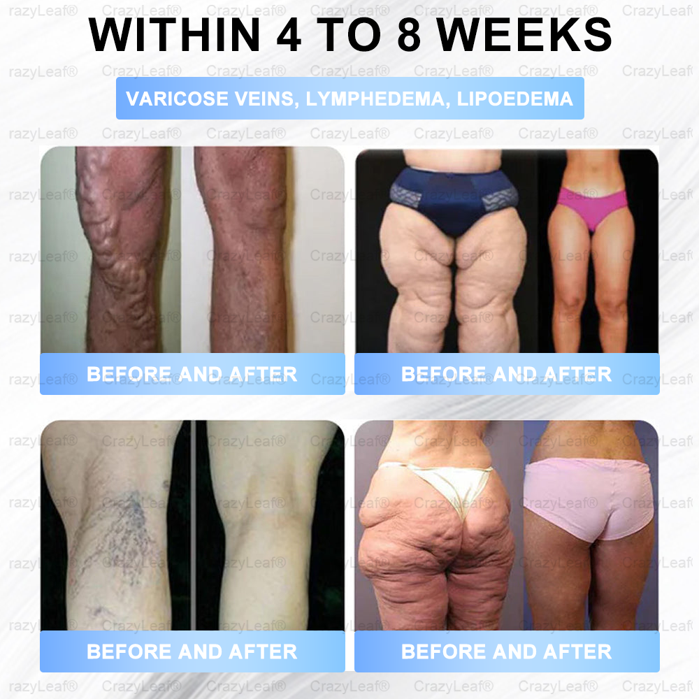 Clinically Proven✨| Official Store |🌸 Buildleaf® Tirzepatide Slimming & Health Nano Microneedle Patch |Targets Obesity, Loose Skin, High Blood Pressure, Diabetes, Fatty Liver, Joint Pain, Brain Fog, Low Energy, Body Aches, and More